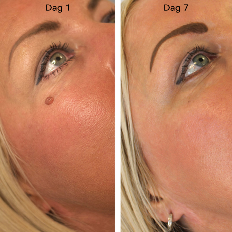 𝐉𝐚𝐬𝐬𝐞𝐞𝐦®- 𝐇𝐮𝐢𝐝 𝐕𝐞𝐫𝐰𝐢𝐣𝐝𝐞𝐫𝐢𝐧𝐠𝐬𝐤𝐢𝐭 𝐕𝐨𝐨𝐫 𝐇𝐮𝐢𝐝𝐥𝐚𝐛𝐞𝐥𝐬（Een echte fysieke oplossing voor het verwijderen van steelwratjes）🍁💖