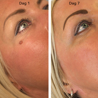 𝐉𝐚𝐬𝐬𝐞𝐞𝐦®- 𝐇𝐮𝐢𝐝 𝐕𝐞𝐫𝐰𝐢𝐣𝐝𝐞𝐫𝐢𝐧𝐠𝐬𝐤𝐢𝐭 𝐕𝐨𝐨𝐫 𝐇𝐮𝐢𝐝𝐥𝐚𝐛𝐞𝐥𝐬（Een echte fysieke oplossing voor het verwijderen van steelwratjes）🍁💖