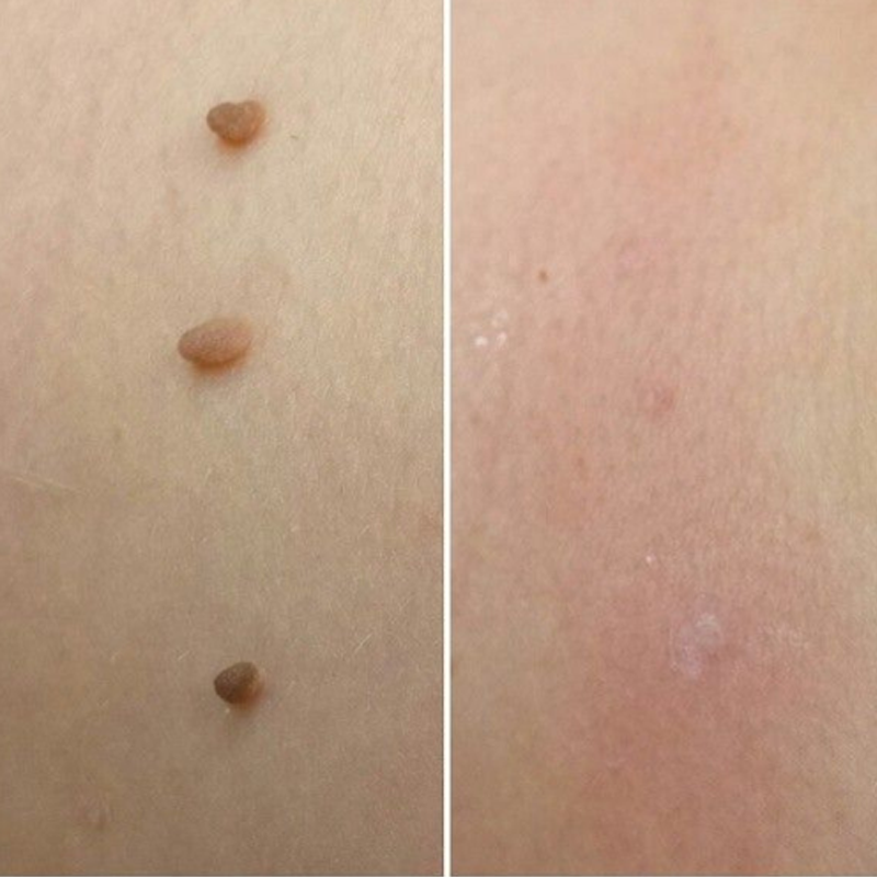 𝐉𝐚𝐬𝐬𝐞𝐞𝐦®- 𝐇𝐮𝐢𝐝 𝐕𝐞𝐫𝐰𝐢𝐣𝐝𝐞𝐫𝐢𝐧𝐠𝐬𝐤𝐢𝐭 𝐕𝐨𝐨𝐫 𝐇𝐮𝐢𝐝𝐥𝐚𝐛𝐞𝐥𝐬（Een echte fysieke oplossing voor het verwijderen van steelwratjes）🍁💖