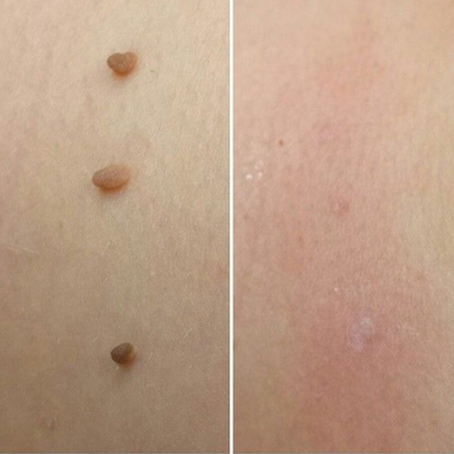 𝐉𝐚𝐬𝐬𝐞𝐞𝐦®- 𝐇𝐮𝐢𝐝 𝐕𝐞𝐫𝐰𝐢𝐣𝐝𝐞𝐫𝐢𝐧𝐠𝐬𝐤𝐢𝐭 𝐕𝐨𝐨𝐫 𝐇𝐮𝐢𝐝𝐥𝐚𝐛𝐞𝐥𝐬（Een echte fysieke oplossing voor het verwijderen van steelwratjes）🍁💖