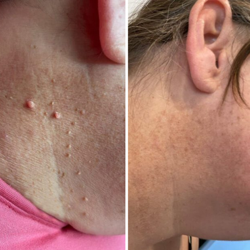 𝐉𝐚𝐬𝐬𝐞𝐞𝐦®- 𝐇𝐮𝐢𝐝 𝐕𝐞𝐫𝐰𝐢𝐣𝐝𝐞𝐫𝐢𝐧𝐠𝐬𝐤𝐢𝐭 𝐕𝐨𝐨𝐫 𝐇𝐮𝐢𝐝𝐥𝐚𝐛𝐞𝐥𝐬（Een echte fysieke oplossing voor het verwijderen van steelwratjes）🍁💖