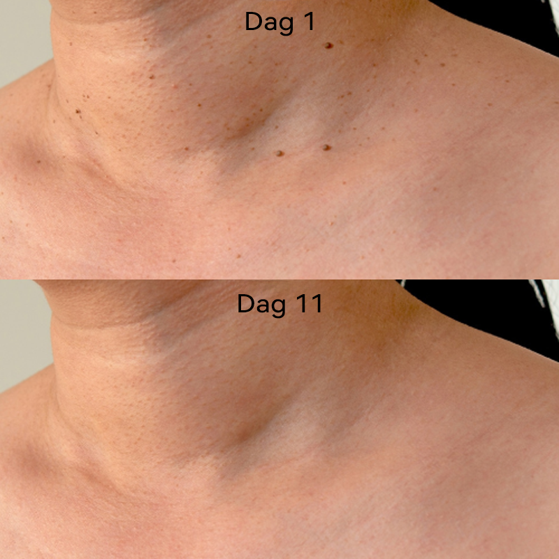 𝐉𝐚𝐬𝐬𝐞𝐞𝐦®- 𝐇𝐮𝐢𝐝 𝐕𝐞𝐫𝐰𝐢𝐣𝐝𝐞𝐫𝐢𝐧𝐠𝐬𝐤𝐢𝐭 𝐕𝐨𝐨𝐫 𝐇𝐮𝐢𝐝𝐥𝐚𝐛𝐞𝐥𝐬（Een echte fysieke oplossing voor het verwijderen van steelwratjes）🍁💖