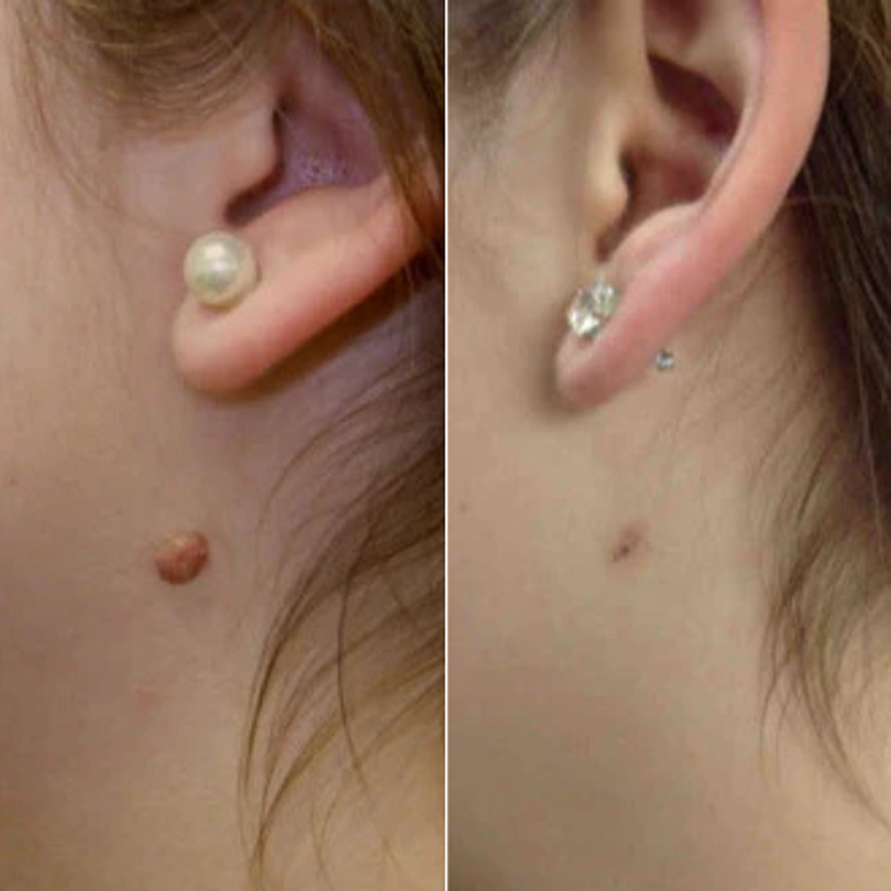 𝐉𝐚𝐬𝐬𝐞𝐞𝐦®- 𝐇𝐮𝐢𝐝 𝐕𝐞𝐫𝐰𝐢𝐣𝐝𝐞𝐫𝐢𝐧𝐠𝐬𝐤𝐢𝐭 𝐕𝐨𝐨𝐫 𝐇𝐮𝐢𝐝𝐥𝐚𝐛𝐞𝐥𝐬（Een echte fysieke oplossing voor het verwijderen van steelwratjes）🍁💖