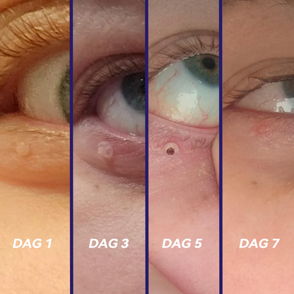 𝐉𝐚𝐬𝐬𝐞𝐞𝐦®- 𝐇𝐮𝐢𝐝 𝐕𝐞𝐫𝐰𝐢𝐣𝐝𝐞𝐫𝐢𝐧𝐠𝐬𝐤𝐢𝐭 𝐕𝐨𝐨𝐫 𝐇𝐮𝐢𝐝𝐥𝐚𝐛𝐞𝐥𝐬（Een echte fysieke oplossing voor het verwijderen van steelwratjes）🍁💖