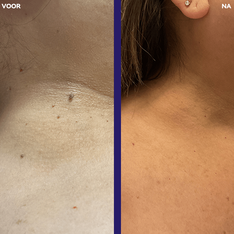 𝐉𝐚𝐬𝐬𝐞𝐞𝐦®- 𝐇𝐮𝐢𝐝 𝐕𝐞𝐫𝐰𝐢𝐣𝐝𝐞𝐫𝐢𝐧𝐠𝐬𝐤𝐢𝐭 𝐕𝐨𝐨𝐫 𝐇𝐮𝐢𝐝𝐥𝐚𝐛𝐞𝐥𝐬（Een echte fysieke oplossing voor het verwijderen van steelwratjes）🍁💖