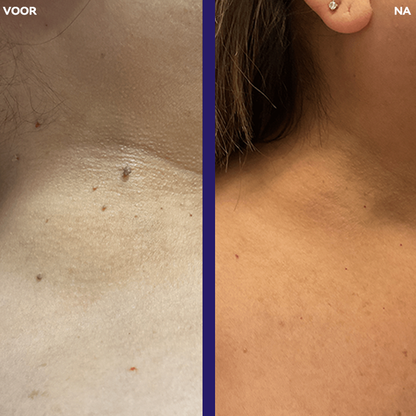 𝐉𝐚𝐬𝐬𝐞𝐞𝐦®- 𝐇𝐮𝐢𝐝 𝐕𝐞𝐫𝐰𝐢𝐣𝐝𝐞𝐫𝐢𝐧𝐠𝐬𝐤𝐢𝐭 𝐕𝐨𝐨𝐫 𝐇𝐮𝐢𝐝𝐥𝐚𝐛𝐞𝐥𝐬（Een echte fysieke oplossing voor het verwijderen van steelwratjes）🍁💖