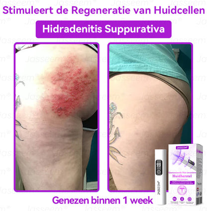 𝐉𝐚𝐬𝐬𝐞𝐞𝐦®𝐆𝐞𝐚𝐯𝐚𝐧𝐜𝐞𝐞𝐫𝐝𝐞 𝐍𝐢𝐞𝐭-𝐢𝐧𝐯𝐚𝐬𝐢𝐞𝐯𝐞 𝐇𝐮𝐢𝐝𝐡𝐞𝐫𝐬𝐭𝐞𝐥 𝐂𝐎₂-𝐋𝐚𝐬𝐞𝐫𝐩𝐞𝐧(Verwijdert op milde wijze wratten, moedervlekken, ouderdomsvlekken en huidflapjes – zonder pijn en zonder gedoe!)🌼💖