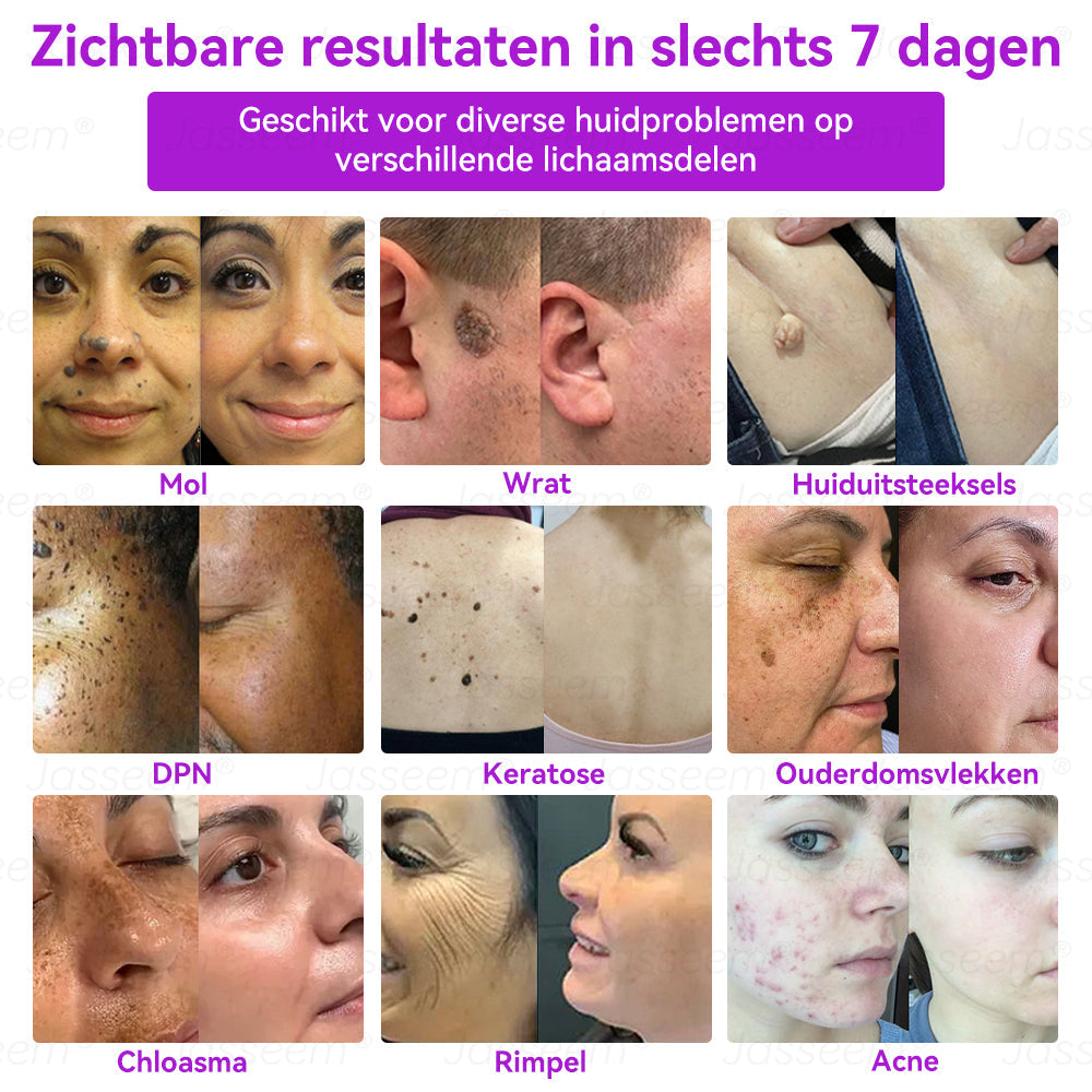 𝐉𝐚𝐬𝐬𝐞𝐞𝐦®𝐆𝐞𝐚𝐯𝐚𝐧𝐜𝐞𝐞𝐫𝐝𝐞 𝐍𝐢𝐞𝐭-𝐢𝐧𝐯𝐚𝐬𝐢𝐞𝐯𝐞 𝐇𝐮𝐢𝐝𝐡𝐞𝐫𝐬𝐭𝐞𝐥 𝐂𝐎₂-𝐋𝐚𝐬𝐞𝐫𝐩𝐞𝐧(Verwijdert op milde wijze wratten, moedervlekken, ouderdomsvlekken en huidflapjes – zonder pijn en zonder gedoe!)🌼💖