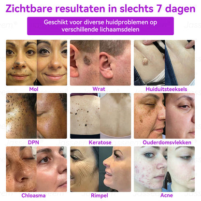 𝐉𝐚𝐬𝐬𝐞𝐞𝐦®𝐆𝐞𝐚𝐯𝐚𝐧𝐜𝐞𝐞𝐫𝐝𝐞 𝐍𝐢𝐞𝐭-𝐢𝐧𝐯𝐚𝐬𝐢𝐞𝐯𝐞 𝐇𝐮𝐢𝐝𝐡𝐞𝐫𝐬𝐭𝐞𝐥 𝐂𝐎₂-𝐋𝐚𝐬𝐞𝐫𝐩𝐞𝐧(Verwijdert op milde wijze wratten, moedervlekken, ouderdomsvlekken en huidflapjes – zonder pijn en zonder gedoe!)🌼💖