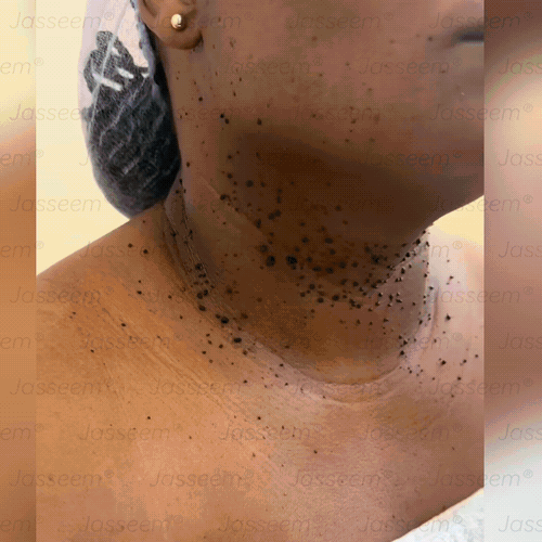 𝐉𝐚𝐬𝐬𝐞𝐞𝐦®𝐆𝐞𝐚𝐯𝐚𝐧𝐜𝐞𝐞𝐫𝐝𝐞 𝐍𝐢𝐞𝐭-𝐢𝐧𝐯𝐚𝐬𝐢𝐞𝐯𝐞 𝐇𝐮𝐢𝐝𝐡𝐞𝐫𝐬𝐭𝐞𝐥 𝐂𝐎₂-𝐋𝐚𝐬𝐞𝐫𝐩𝐞𝐧(Verwijdert op milde wijze wratten, moedervlekken, ouderdomsvlekken en huidflapjes – zonder pijn en zonder gedoe!)🌼💖